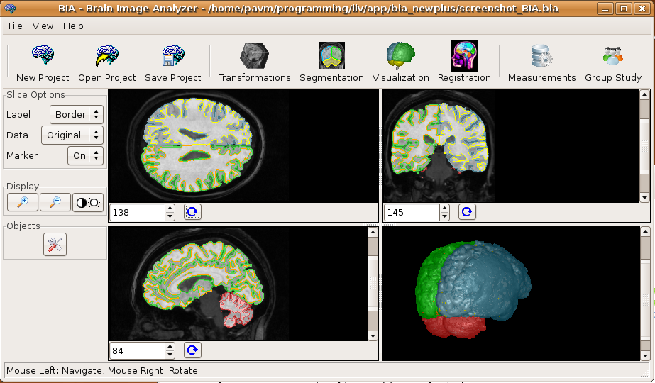 System for brain asymmetry analysis under development
